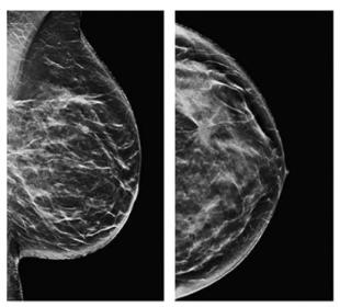 Breast Image Analytics